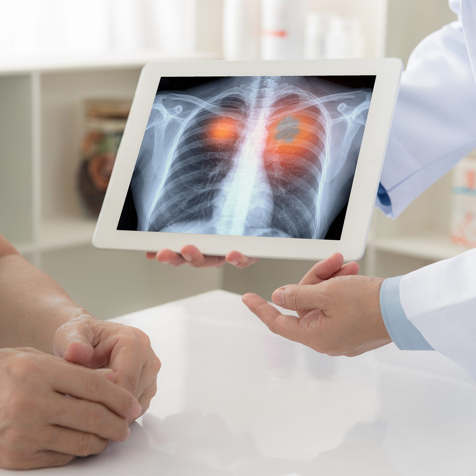 الجمعية الإسرائيلية لسرطان الرئة: “إدراج فحص الكشف” المبكر ضمن سلّة الخدمات الصحية – خطوة تنقذ الأرواح